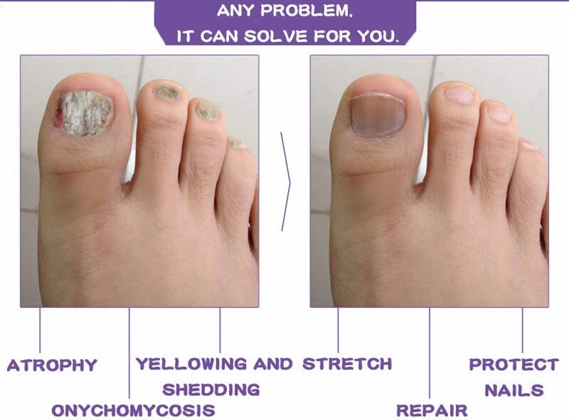 Nail Fungal Treatment Gel Foot Toenail Fingernail Renewal Repair Fungus Removal