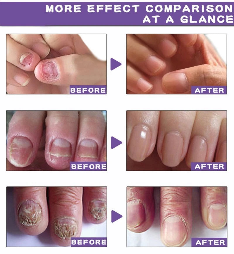 Nail Fungal Treatment Gel Foot Toenail Fingernail Renewal Repair Fungus Removal