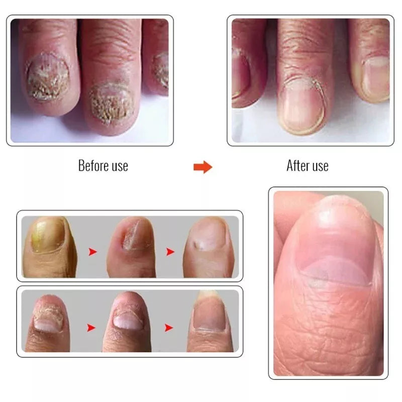 Nail Fungal Treatment Gel Foot Toenail Fingernail Renewal Repair Fungus Removal